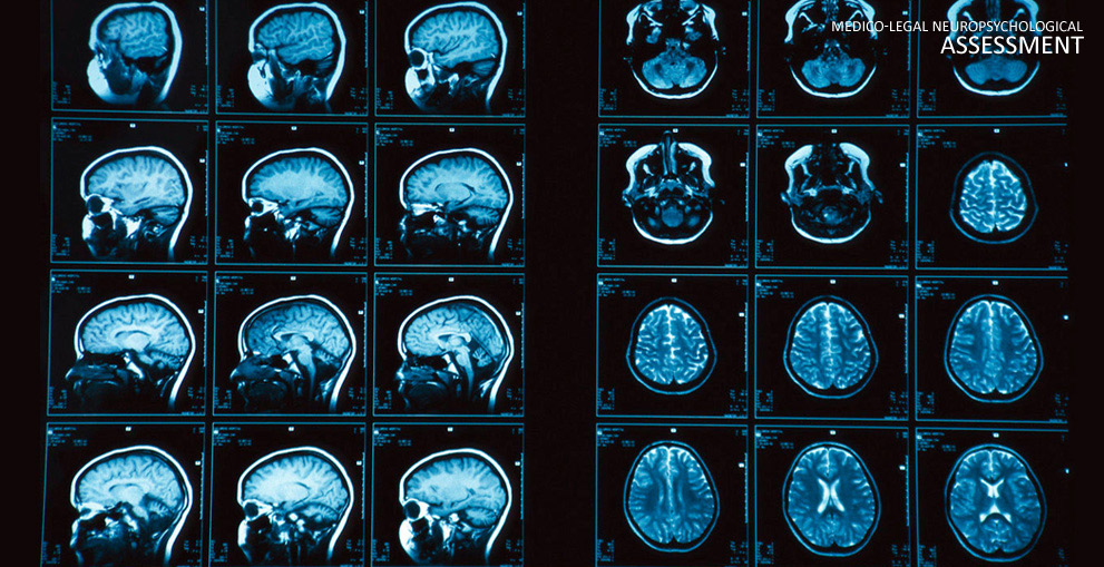 brain injuries